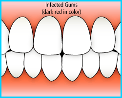 gingivitis