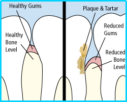 periodontitis